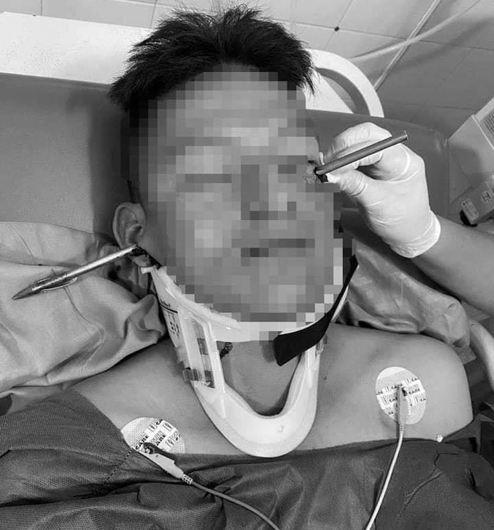 Hombre estuvo a punto de perder un ojo mientras pescaba en una quebrada 1