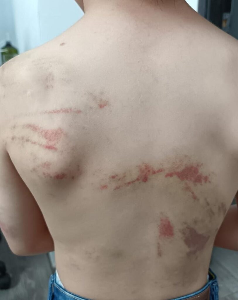 Capturado por provocar lesiones a su hijo durante un castigo 1